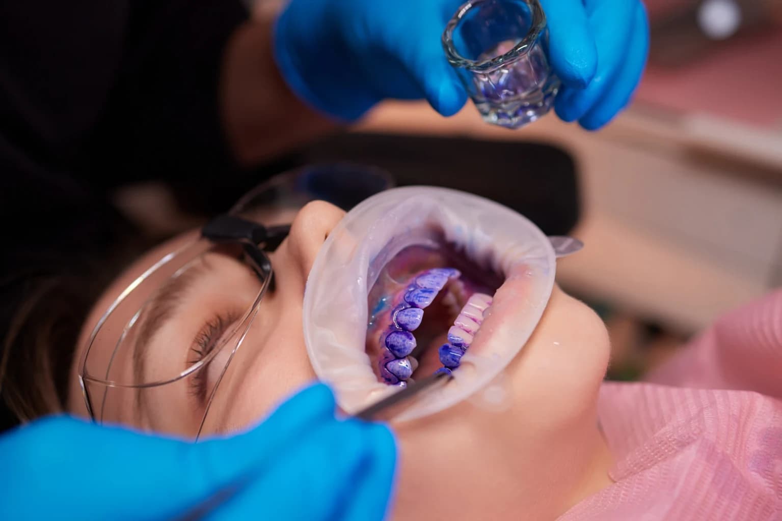 Igiene professionale nel bambino: l’air-flow guidato dalla placca può fare la differenza