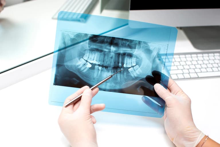Lesioni periapicali estese: i fattori che influenzano il successo della chirurgia endodontica
