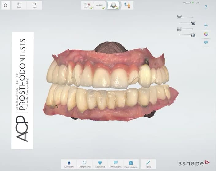 Quando la protesizzazione implantare fallisce: un workflow digitale per semplificare il retreatment