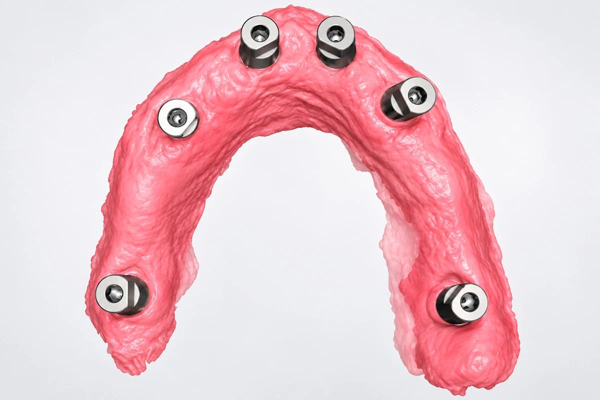 Scansioni implantari full-arch, il trasferimento extraorale migliora la precisione