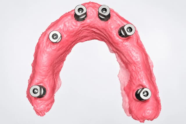 Scansioni implantari full-arch, il trasferimento extraorale migliora la precisione