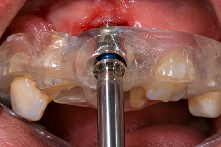 Socket-shield e chirurgia guidata: i risultati di una nuova procedura digitale