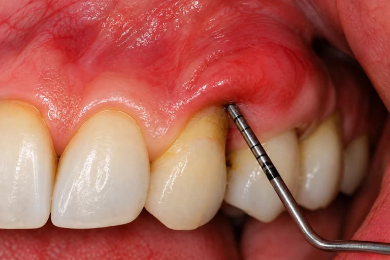 Urgenze parodontali, le nuove linee guida EFP chiariscono diagnosi e trattamento
